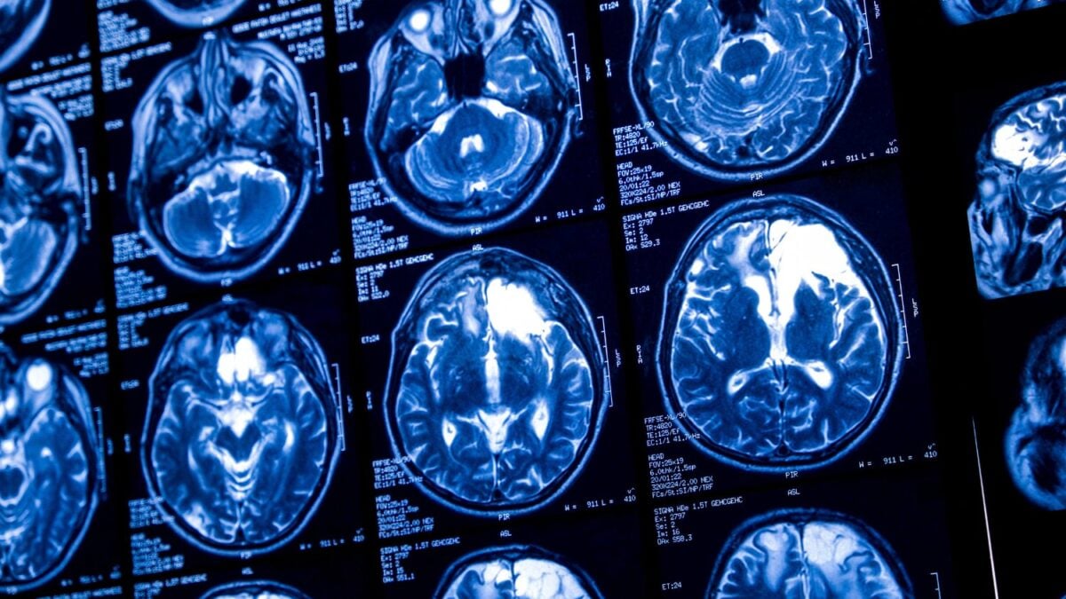 Sam Altman Reportedly Launch Rival Brain-Chip Startup to Compete With Musk’s Neuralink